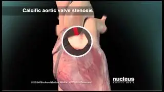 Transcatheter Aortic Valve Implantation