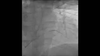 Guidezilla II Catheter to Deliver A Stent in Severe Angulation of Left Main -LAD:Step by Step Lesson