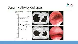 Understanding Dynamic Collapse of the Airways