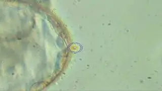 Minimal Impact Biopsy of human embryo (MIB) by Dr. Dmitri Dozortsev