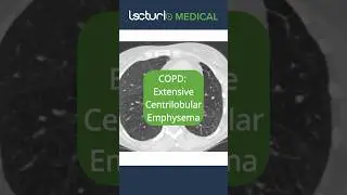 🔍 CT Scans Unveiled: Centrilobular Emphysema! #Emphysema #Radiology #usmle #copd
