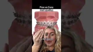 Self Ligating Braces!