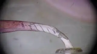 Filling the simulated canal with AdSeal beyond the separated instrument