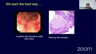 Inflammatory Bowel Disease Mimics