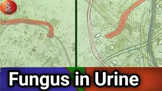 Fungus seen under the microscope in urine sometimes || Fungus||Microscope