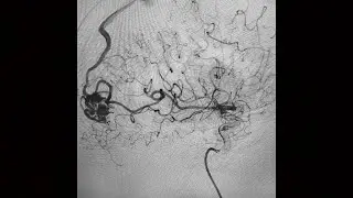 Gogan - Neurointerventionalist