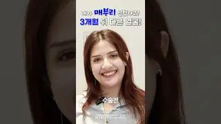 못 알아볼 정도로 달라진 매부리코, 3개월 뒤 모습 공개 #매부리코 #복코 #리터닝성형외과