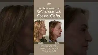 For a smoother, more confident you, try Forehead Lift with Stem Cells!
