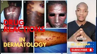 DRUG REACTIONS IN DERMATOLOGY BY DR ABRAHAM #TEN #SJS #DRUG RASH #dermatology #lecture