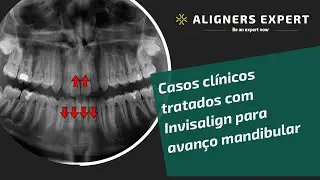 Casos clínicos tratados com Invisalign para avanço mandibular