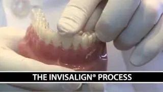 Invisalign San Jose, CA -- Clear Braces Orthodontics