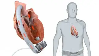CorWave Left Ventricular Assist Device (LVAD) | Ghost Medical Animation