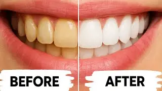 Fix Yellow Teeth Naturally &mdash; The Ultimate Teethmaxxing Guide