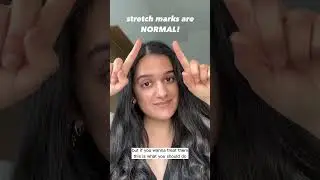 How to treat stretch marks