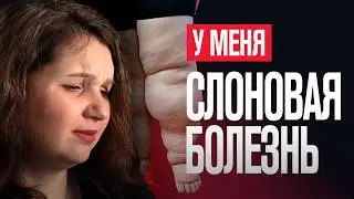 Спасите мои ноги! Если отёки не проходят - это ЛИМФОСТАЗ. Мы лечим слоновость.
