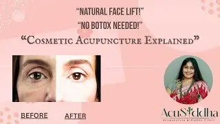 No Botox, No Chemicals! | The Powerof CosmeticAcupuncture.#acupuncture #beauty  #CosmeticAcupuncture