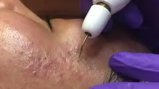 Fibroblast