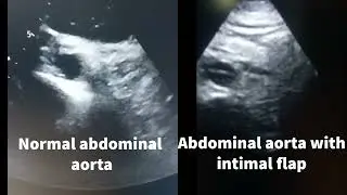 Stanford Type B aortic dissection