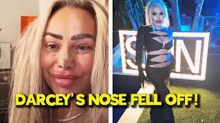 Darcey Silva&rsquo;s Nose Collapses Following Severe Facial Plastic Surgeries