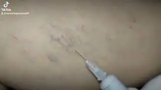 Tĩnh mạch mạng nhện (spidervein)