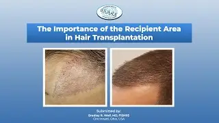 The Importance of the Recipient Area in Hair Transplantation Surgery | Bradley R. Wolf, MD, FISHRS