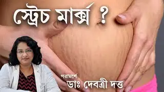 স্ট্রেচ মার্ক্স্-এর কার্যকরী চিকিৎসা | Stretch marks Treatment options| Dermatologist recommends