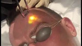 Laser Resurfacing - Cutera Pearl Fusion by Dr Stephen Lowe