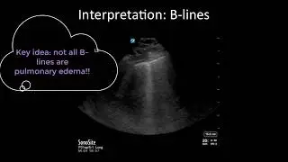 Pitfalls of Lung Ultrasound