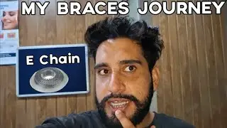 My Braces Journey 😬 Part 5 | E chain kya hoti hai | Orthodontist | Smile 😃 Recovery 
