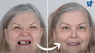Her Review of All on 4 Dental Implants in Thailand (Depression No More!)