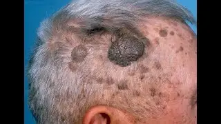 Seborrheic Keratosis Explained | Common Benign Skin Growths in Dermatology