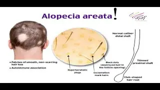 Alopecia areata (Autoimmune mediated Hair loss); Definition, Causes, Symptoms, Diagnosis, Treatment