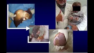 Pediatric transplantation history ... and last frontiers