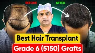 Best Hair Transplant in Agra (5150 Grafts Norwood Grade 6 Hair Loss) at Saraswat Hospital, India