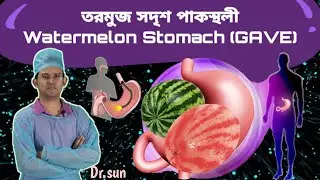 তরমুজ সদৃশ পাকস্থলী || Watermelon Stomach (GAVE) || Dr.sun