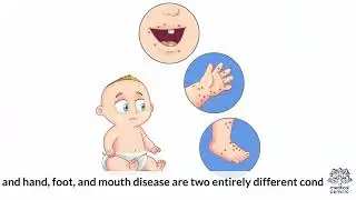 What is Chemotherapy Hand-Foot Syndrome?