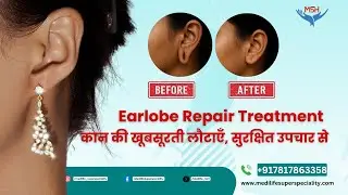 Earlobe Repair Treatment at Medilife Hospital Dehradun I Dr. Rikta Roy