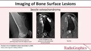 Imaging of Bone Surface Lesions dr  Sara SAKR