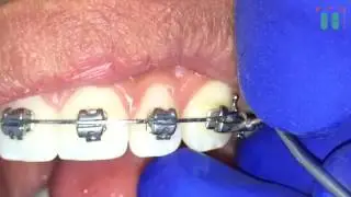 Como abrir e fechar o clip do Braquete Portia 3M - Prof.  Marden Bastos