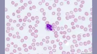 Hematopathology-Myeloid-Anaplasmosis.mp4