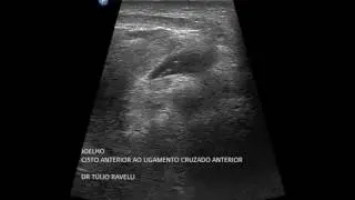 Ultrassonografia do Joelho