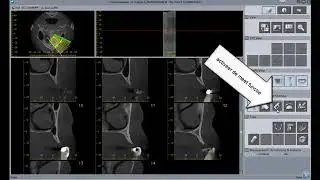 Morita i Dixel Medicion