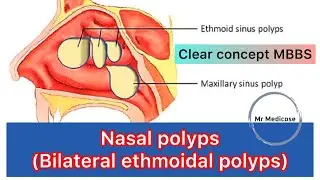Nasal polyps | Bilateral ethmoidal polyps