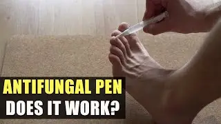 Antifungal Pen Review Of A Person With Toenail Fungus - This Thing Shocked Me!