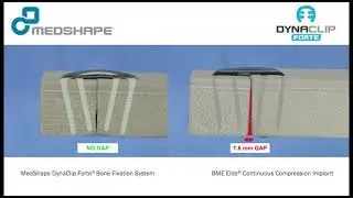 DynaClip Forte&reg; Dynamic Compression to Reduce Plantar Gapping