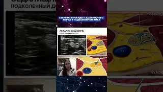 Блокада седалищного нерва в подколенной ямке.