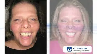Margaret&rsquo;s Smile Makeover Journey | All-on-4 Dental Implants Transformation