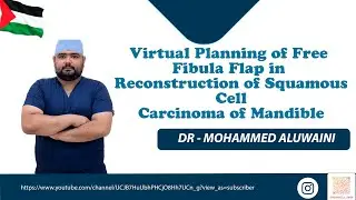 Virtual Planning of Free Fibula Flap in Reconstruction of Squamous Cell Carcinoma of Mandible