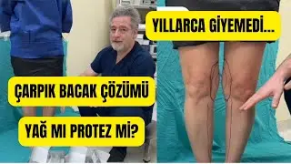 &Ccedil;arpık Bacak Tedavisi: Bacak Protezi mi Yağ Enjeksiyonu mu?