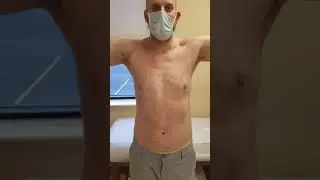 2 Months Post-op Pec Tendon Repair | Dr. Sunil Thacker | Seaview Orthopaedic & Medical Associates